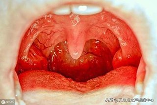 扁桃体发炎的偏方